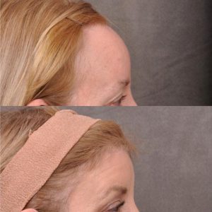 ForeheadPlasty / Hairline Lowering - Right Side