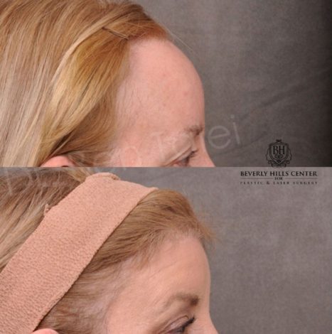 ForeheadPlasty / Hairline Lowering - Right Side