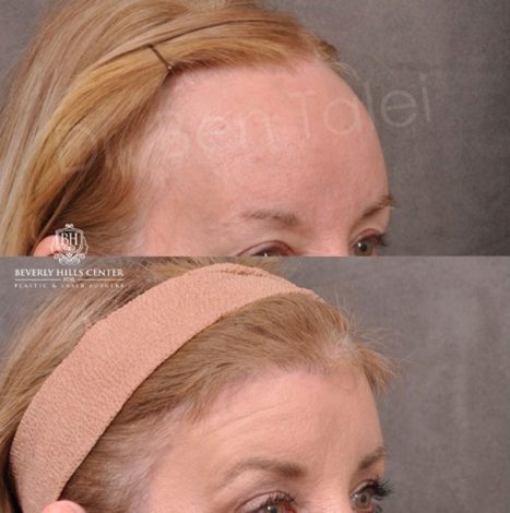 ForeheadPlasty / Hairline Lowering - Right Side