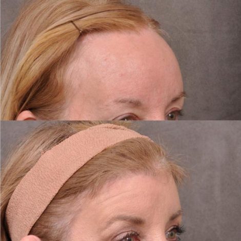 ForeheadPlasty / Hairline Lowering - Left Side