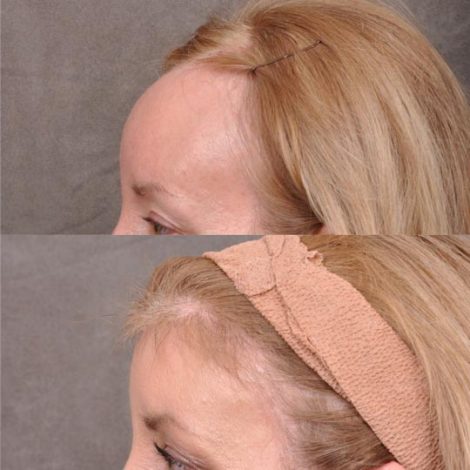 ForeheadPlasty / Hairline Lowering - Left Side