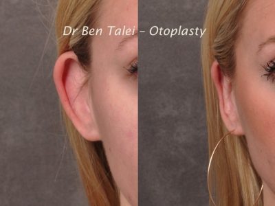 Otoplasty (Ear Pinning and Reshaping)