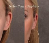 Beverly Hills Center Female Patient Before & After Otoplasty