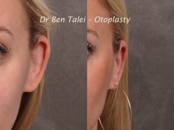 Beverly Hills Center Female Patient Before & After Otoplasty