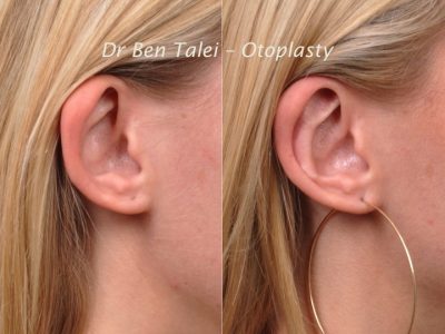 Otoplasty (Ear Pinning and Reshaping)