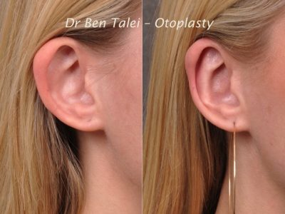 Otoplasty (Ear Pinning and Reshaping)