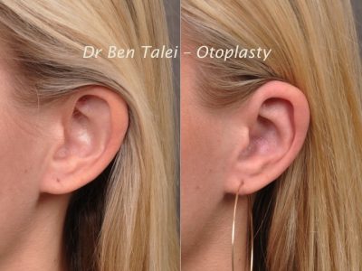 Otoplasty (Ear Pinning and Reshaping)