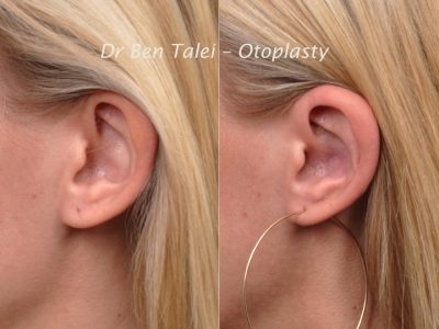 Otoplasty (Ear Pinning and Reshaping)