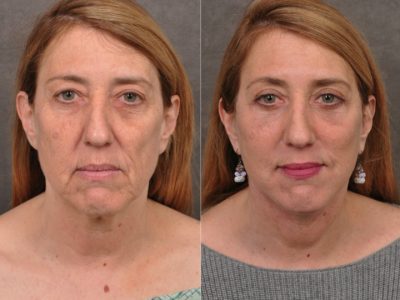 AuraLyft, Upper & Lower Eyelids, CO2 upper lip - Front