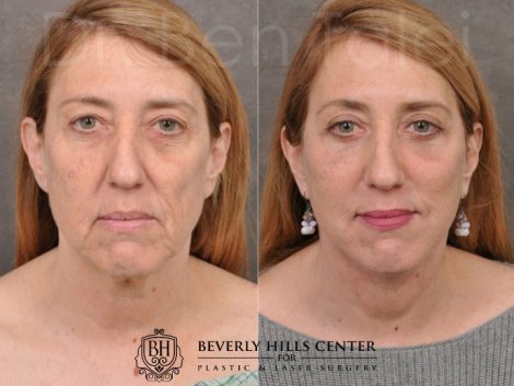 AuraLyft, Upper & Lower Eyelids, CO2 upper lip - Front