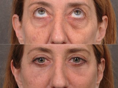 AuraLyft, Upper & Lower Eyelids, CO2 upper lip - Front