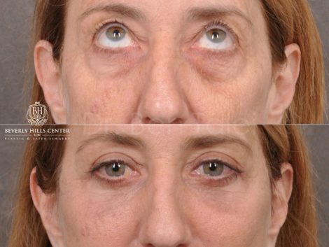 AuraLyft, Upper & Lower Eyelids, CO2 upper lip - Front
