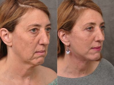 AuraLyft, Upper & Lower Eyelids, CO2 upper lip – Right Side
