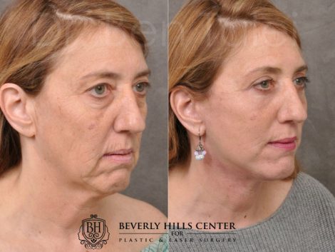 AuraLyft, Upper & Lower Eyelids, CO2 upper lip - Right Side