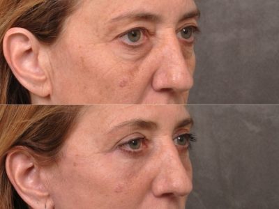 AuraLyft, Upper & Lower Eyelids, CO2 upper lip – Right Side