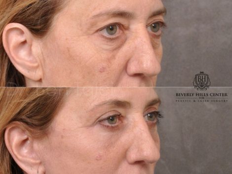 AuraLyft, Upper & Lower Eyelids, CO2 upper lip - Right Side