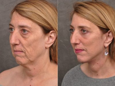AuraLyft, Upper & Lower Eyelids, CO2 upper lip – Left Side