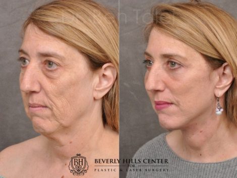 AuraLyft, Upper & Lower Eyelids, CO2 upper lip - Left Side