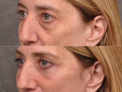 AuraLyft, Upper & Lower Eyelids, CO2 upper lip – Left Side