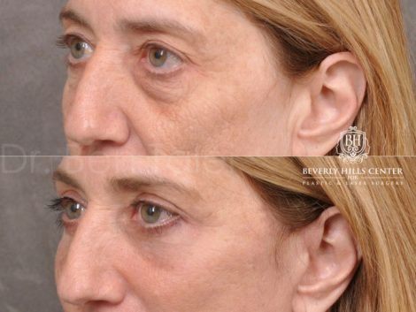 AuraLyft, Upper & Lower Eyelids, CO2 upper lip - Left Side