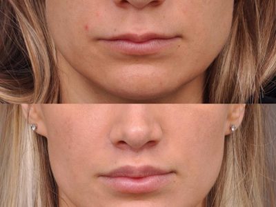 Modified Upper Lip Lift - Front