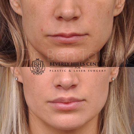 Modified Upper Lip Lift - Front