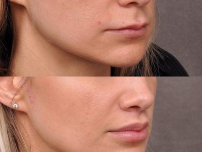 Modified Upper Lip Lift - Right Side
