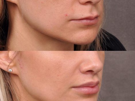 Modified Upper Lip Lift - Right Side