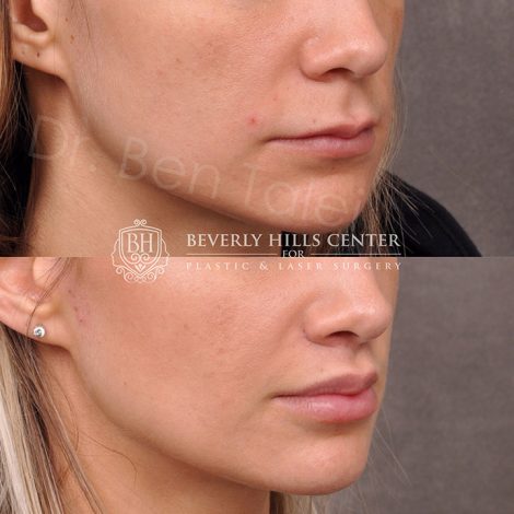 Modified Upper Lip Lift - Right Side
