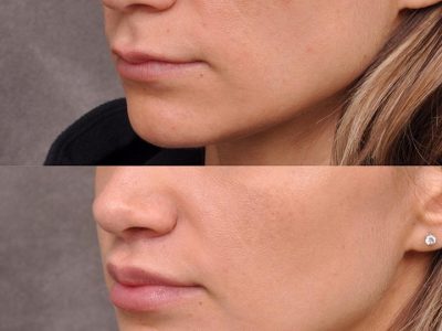 Modified Upper Lip Lift - Left Side