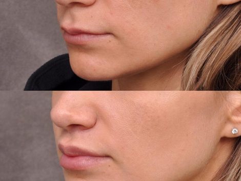 Modified Upper Lip Lift - Left Side