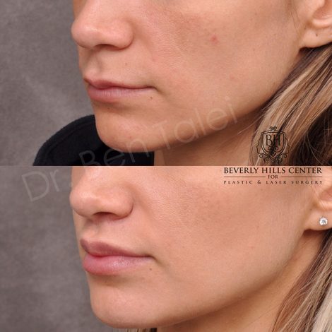 Modified Upper Lip Lift - Left Side