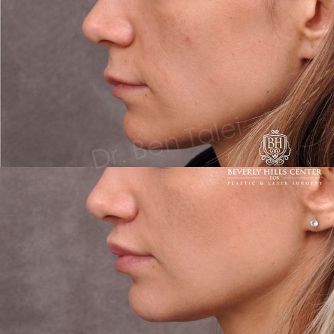 Modified Upper Lip Lift - Left Side