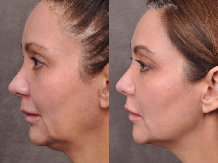 Laser Facelift / Profound MicroLift Before & Afters Beverly Hills