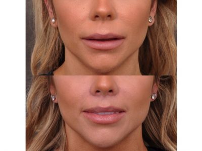 Modified Upper Lip Lift - Front