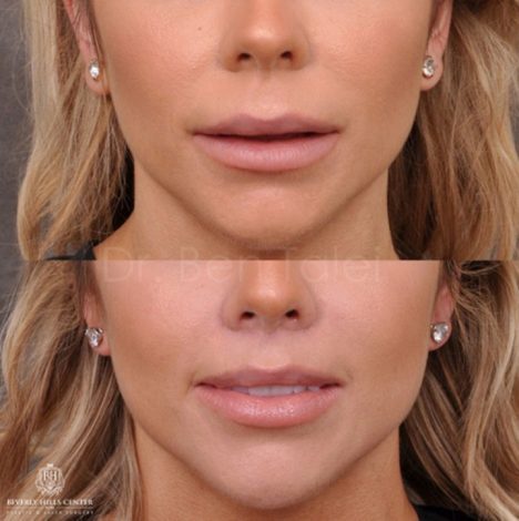Modified Upper Lip Lift - Front