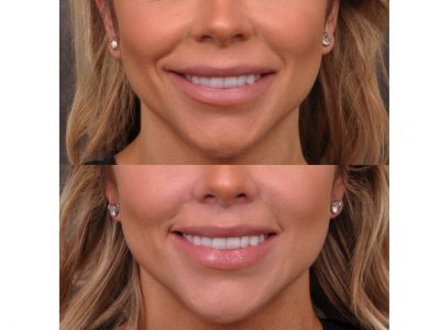 Modified Upper Lip Lift - Front
