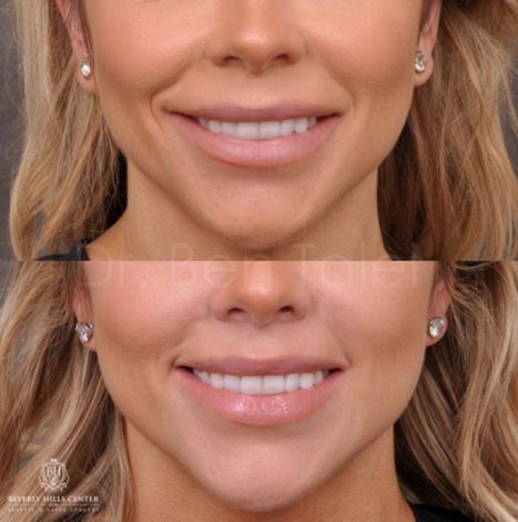 Modified Upper Lip Lift - Front