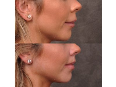 Modified Upper Lip Lift - Right Side