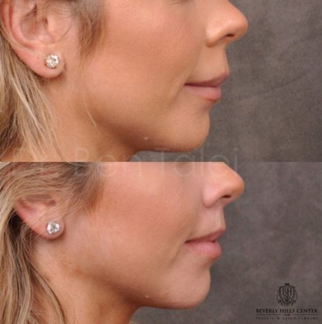 Modified Upper Lip Lift - Right Side