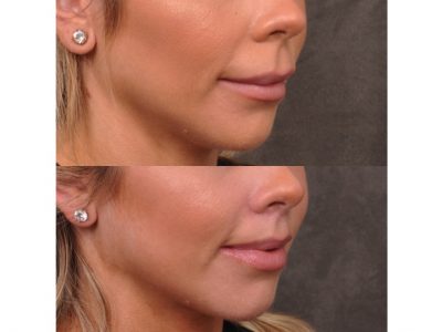 Modified Upper Lip Lift - Right Side