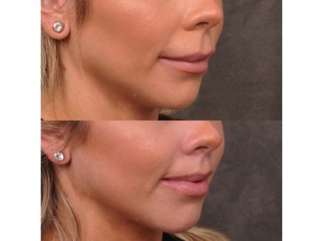 Modified Upper Lip Lift - Right Side