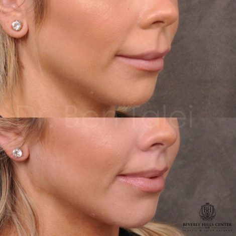 Modified Upper Lip Lift - Right Side