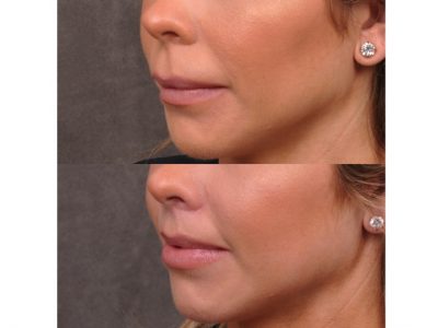 Modified Upper Lip Lift - Left Side
