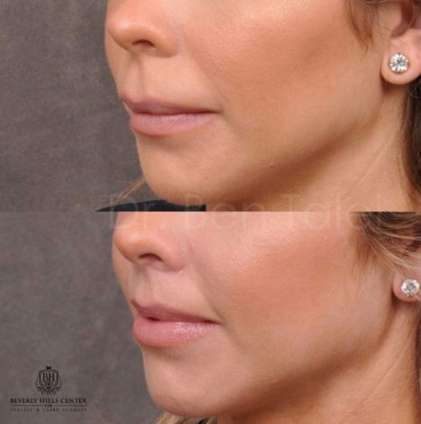 Modified Upper Lip Lift - Left Side