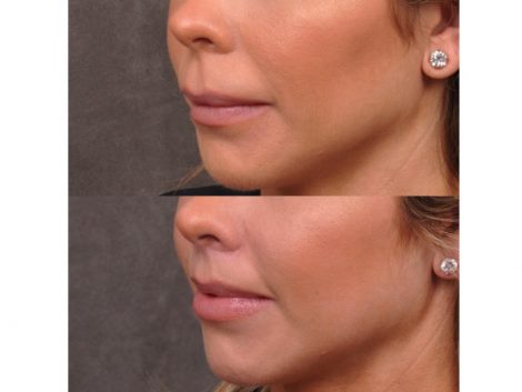 Modified Upper Lip Lift - Left Side