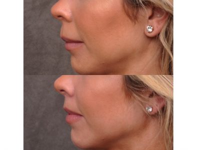Modified Upper Lip Lift - Left Side