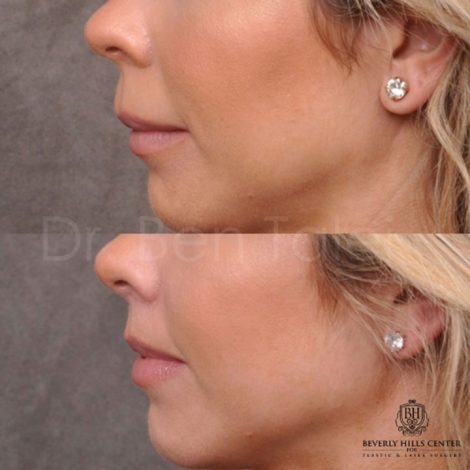 Modified Upper Lip Lift - Left Side