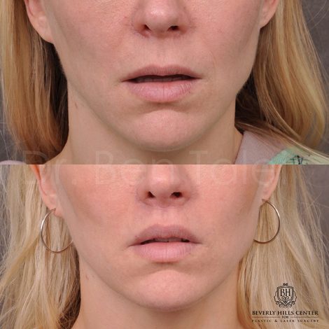 Modified Upper lip lift - Front