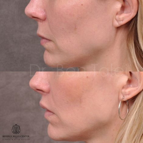 Modified Upper lip lift - Left side